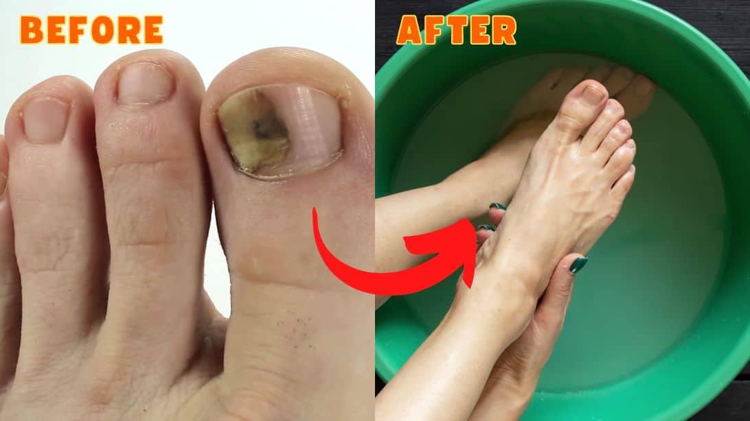 10 Effective & Natural Cure For Toenail Fungus