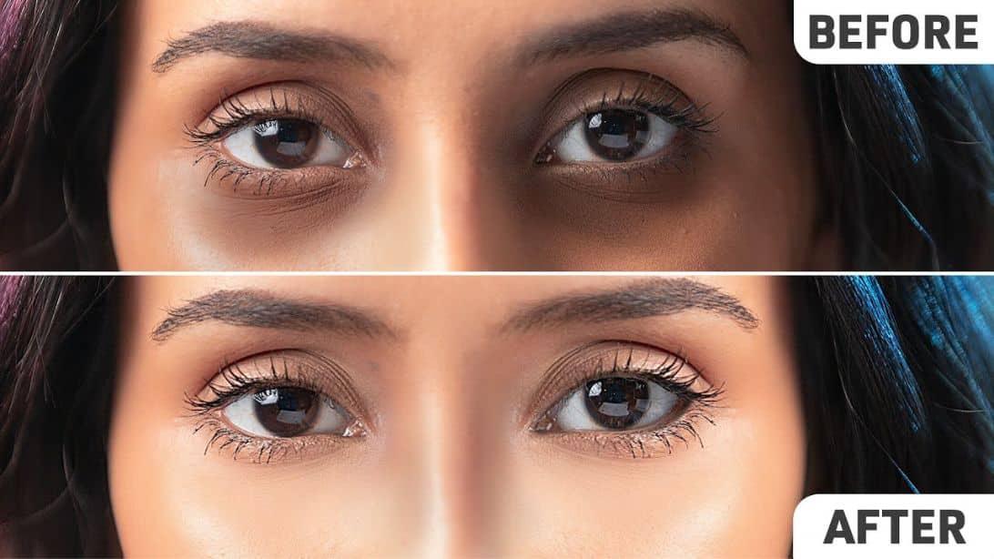 How to Remove Dark Circles Under Your Eyes