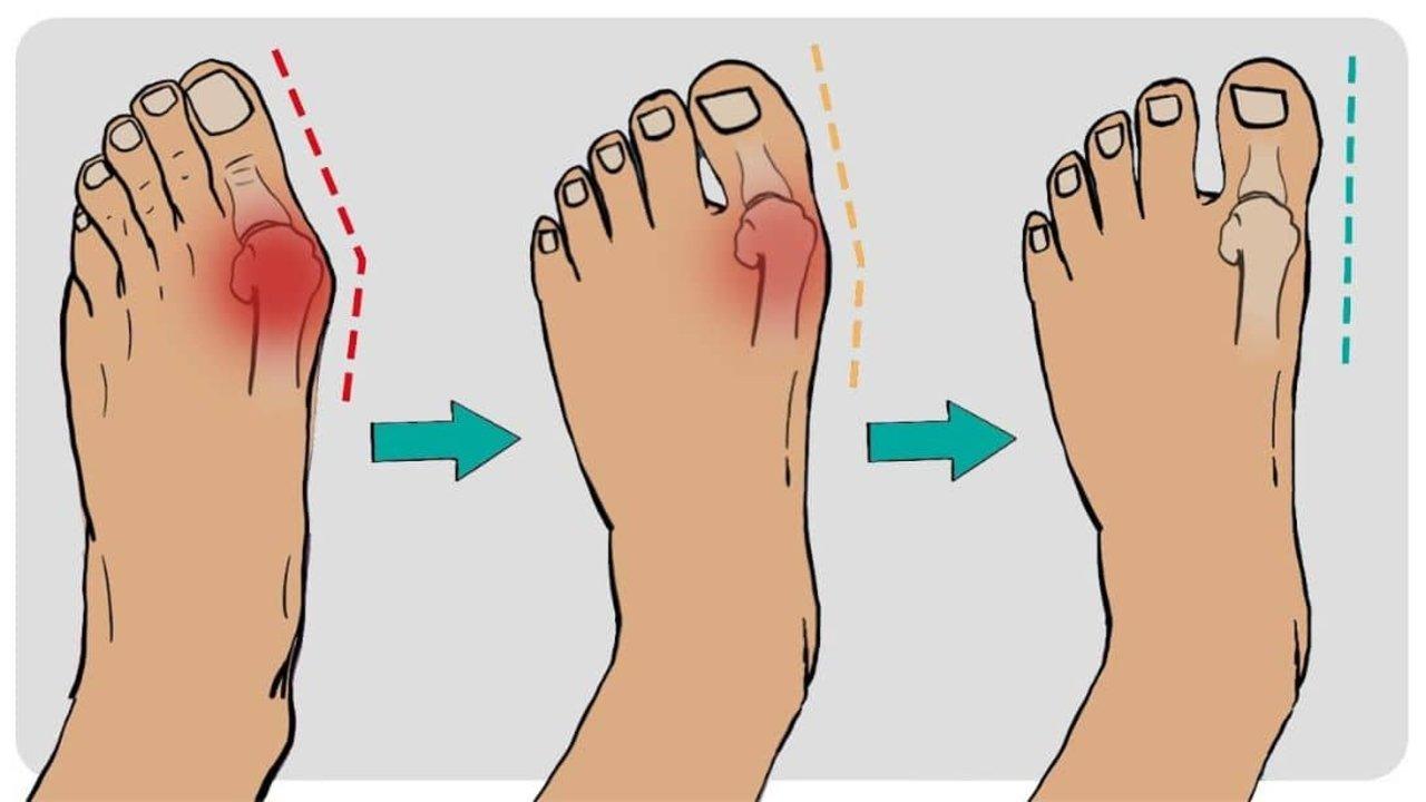 How to Fix Bunions in 5 Steps