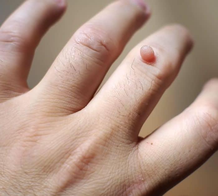 Why You Should Never Throw Away Potato Peels Wart Removal