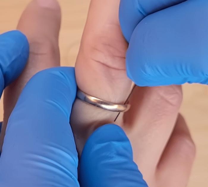 Easy Way to Remove Stuck Ring on Finger
