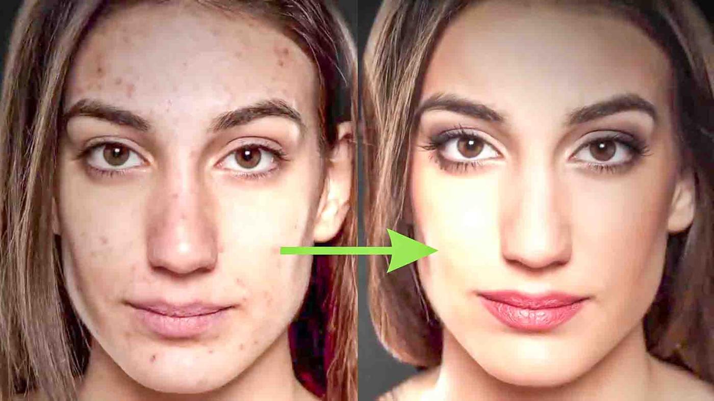 8 Quick Ways To Get Rid Of Acne Scars For Good