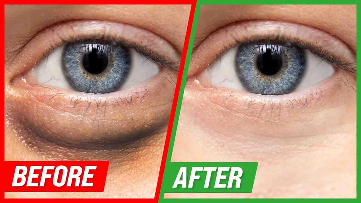 4 Ways To Get Rid Of Puffy Eyes And Dark Circles