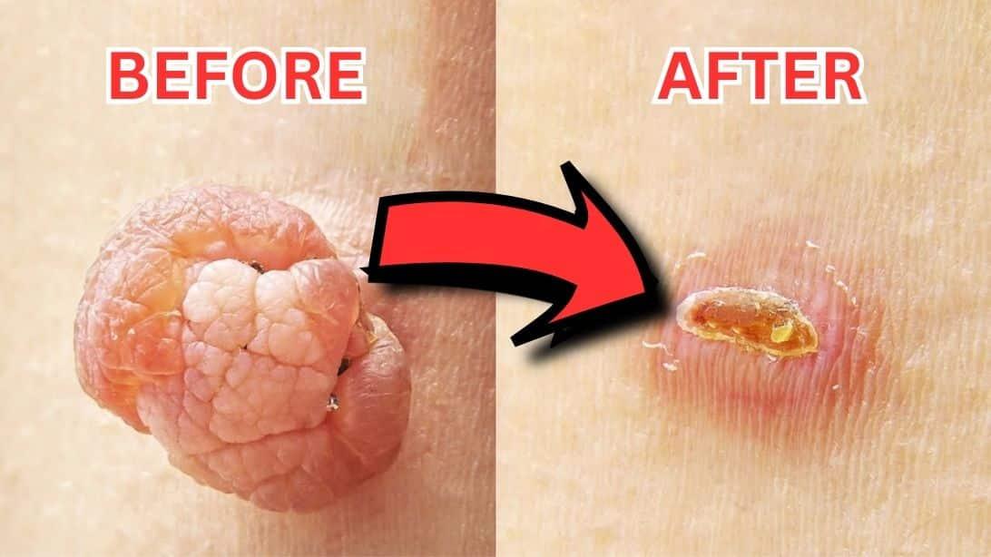 How To Remove A Mole With Castor Oil