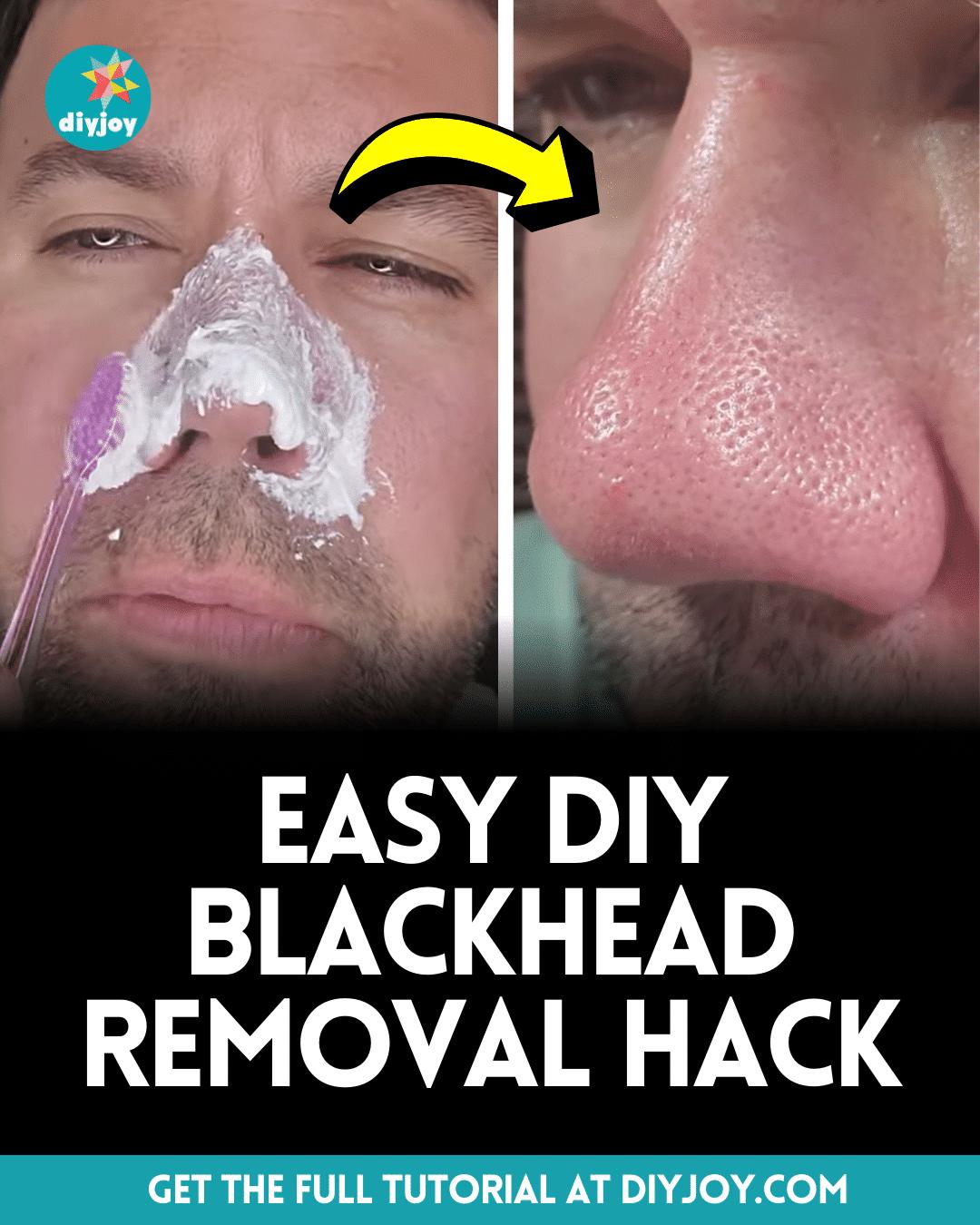 Easy DIY Blackhead Removal Hack