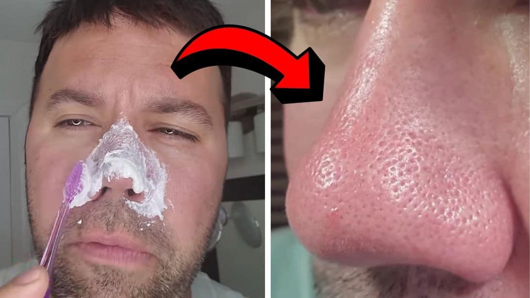 Easy DIY Blackhead Removal Hack