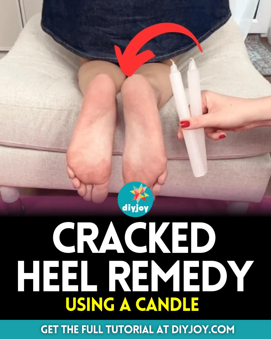 Easy Cracked Heel Remedy Using a Candle
