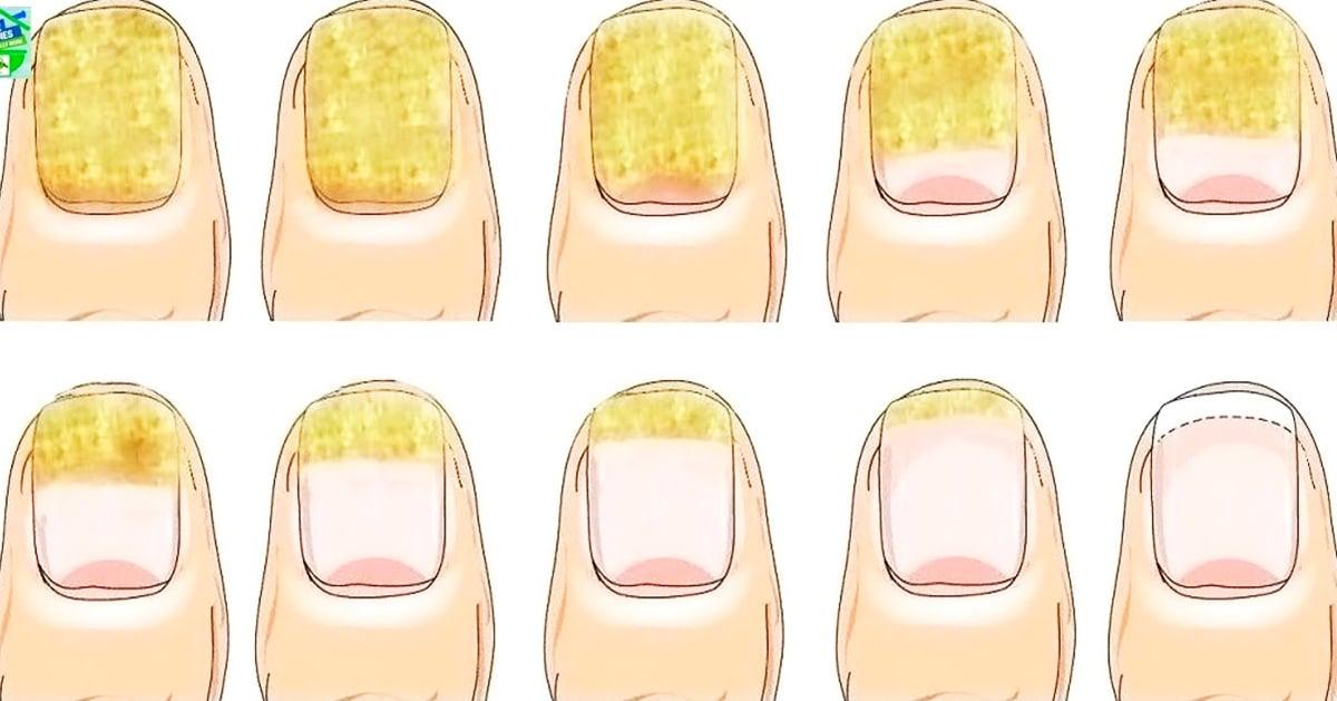 How To Get Rid Of Toenail Fungus Naturally