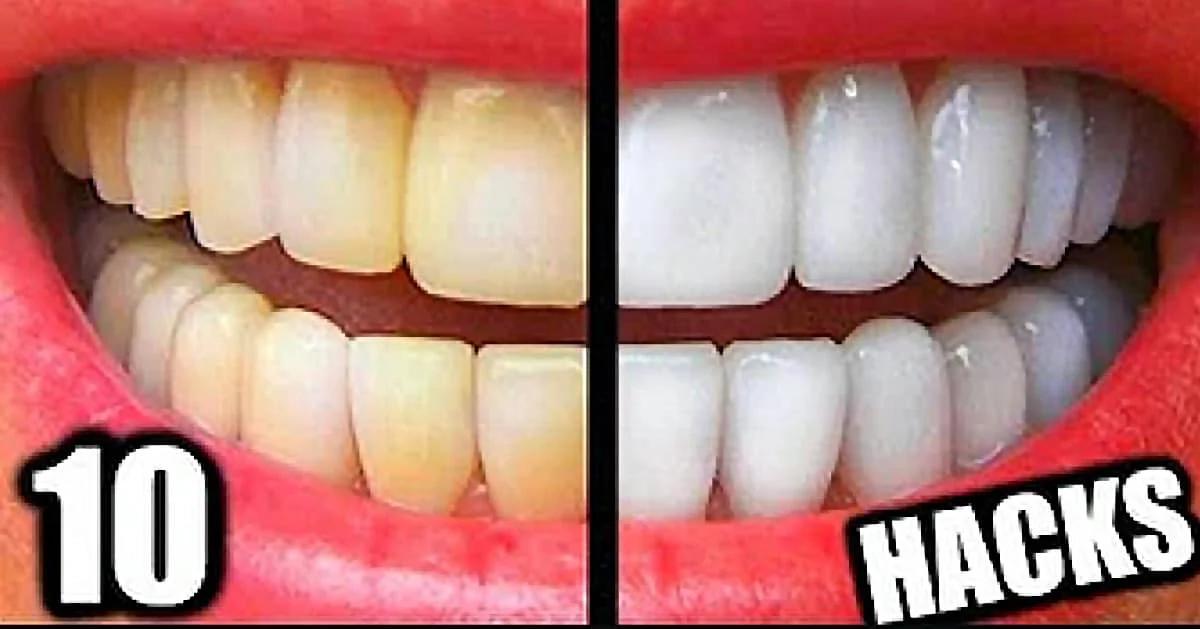 Everyone Can Have Super White Teeth Thanks to These 10 Easy Hacks