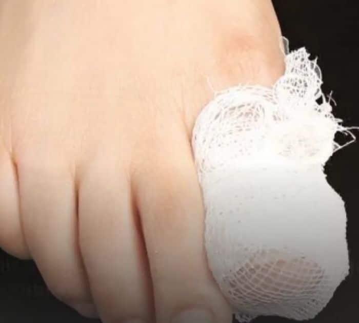 How To Use Vicks Vaporub For Toenail Fungus