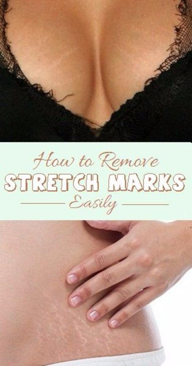 Remove Stretch Marks Easily, budget friendly using stuff most people already own and the fix worth remembering