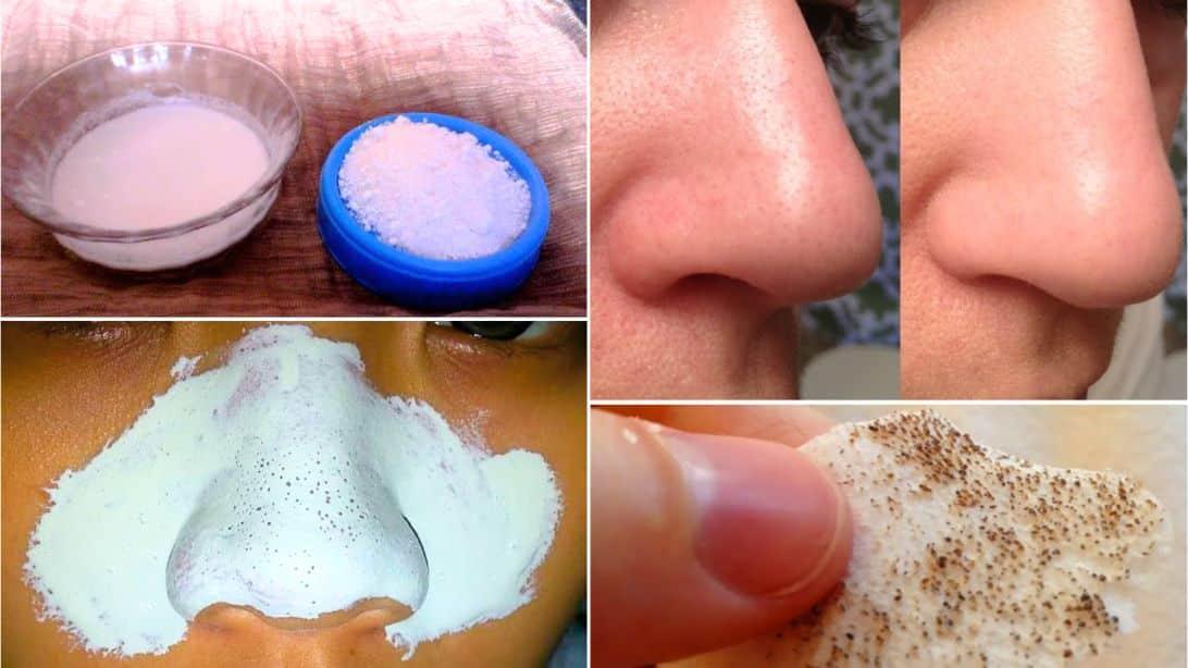 How to Remove Blackheads Naturally