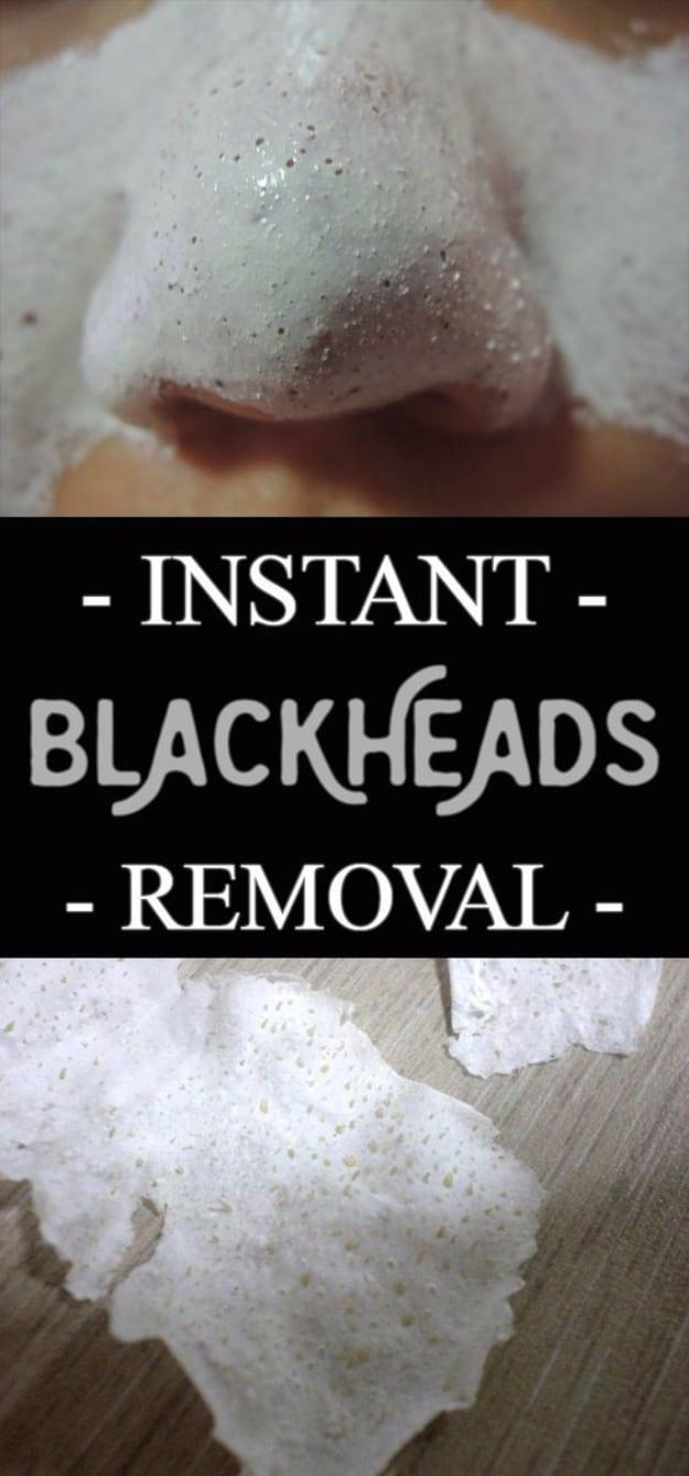 Instant Blackheads Removal, quick and cheap to try tonight and the fix that ends the daily hassle for good