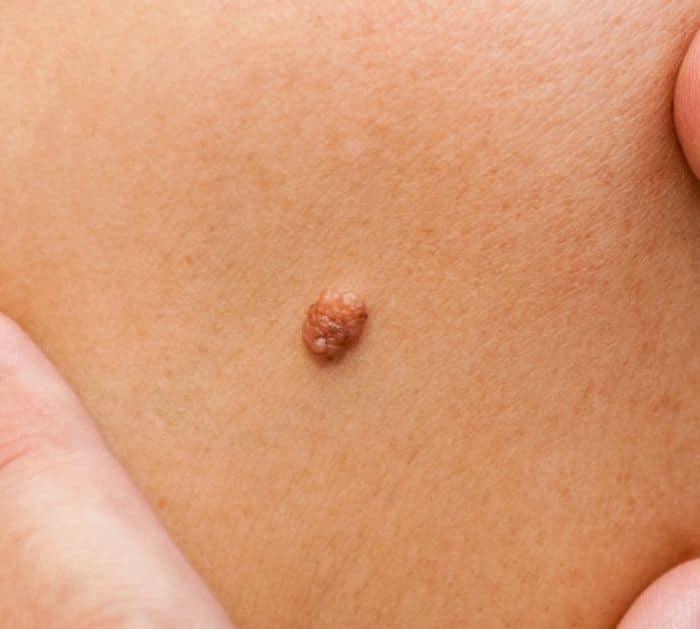 How to Remove Moles Naturally