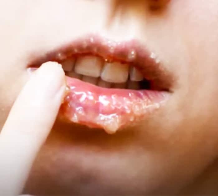Best At Home Remedies To Get Rid Of Chapped Lips - How To Avoid Dry Lips - How To Keep Your Lips Moist In The Winter
