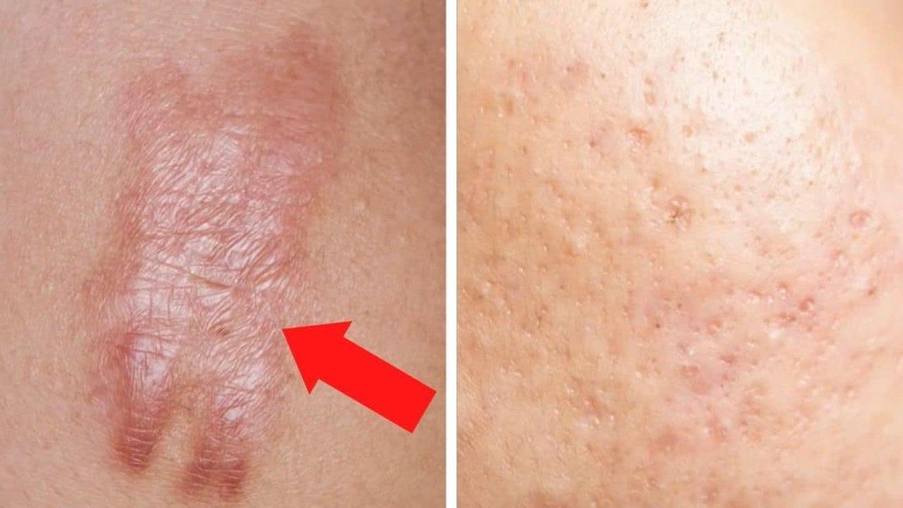 How to Get Rid of Scars Forever
