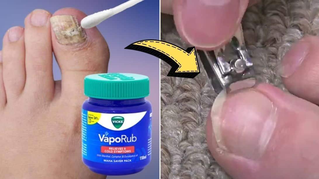 How To Treat Toenail Fungus With Vicks Vaporub