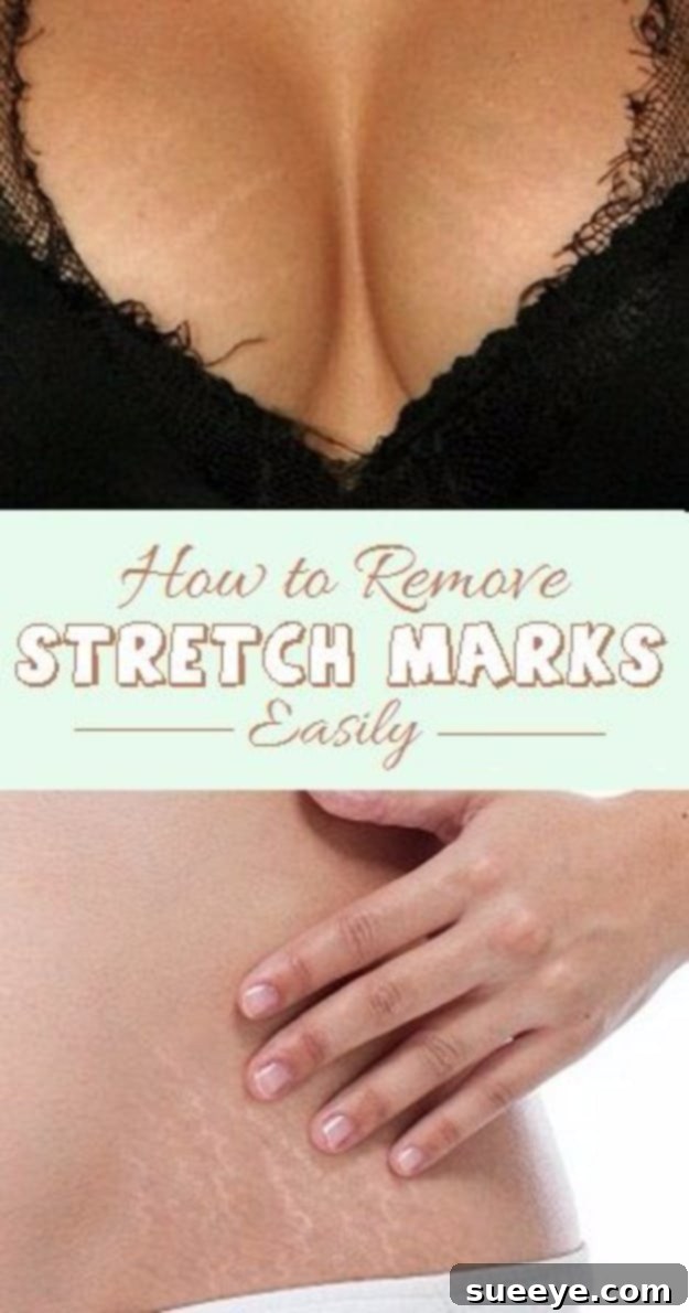 DIY Beauty Hack: Remove Stretch Marks Easily using natural methods and oils