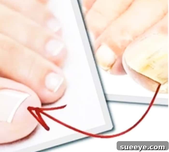 Natural Remedies for Toenail Fungus 2 Person's foot with toenail fungus, showing yellowed and thickened nails, illustrating the need for treatment.